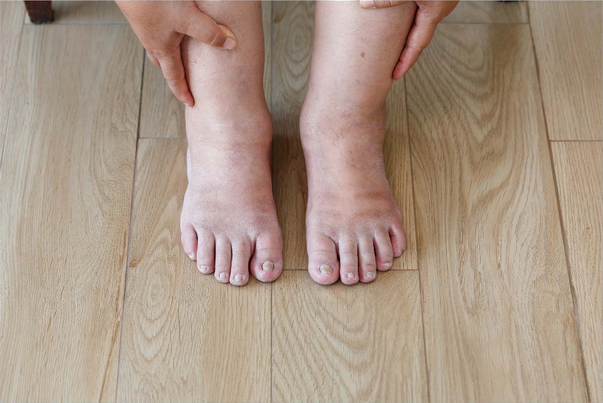 Swollen Legs, Ankles & Lymphoedema Treatment | My Podiatrist